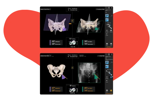Ρομποτική Χειρουργική Ισχίου