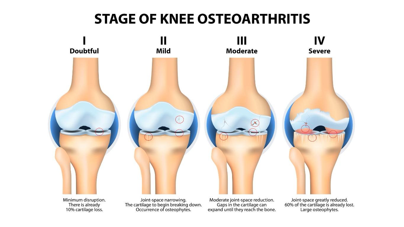Στάδια Οστεοαρθρίτιδας Γόνατος