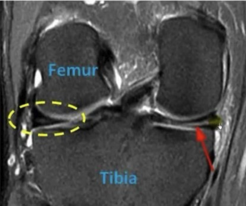 MRI Ρήξης Μηνίσκου